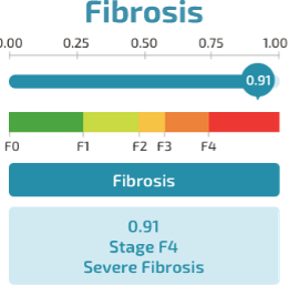 fibrosis score chart